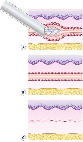 Figure 7.1, Diagrammatic representation of the mechanism of action for sclerotherapy. A, Proper placement of needle into the vein and release of sclerosing solution. B, Early stage of endothelial destruction and minimal organizing thrombosis. C, Late stage demonstrating fibrous cord formation.