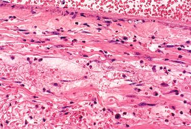 Figure 7.11, Vessel 2 days after injection of sodium morrhuate 1%. Note the large numbers of perivascular mast cells (hematoxylin–eosin, ×400).