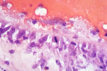 Figure 7.14, Endothelial regeneration is apparent 4 days after injection of polidocanol 0.25% in the rabbit ear vein (hematoxylin–eosin, ×100).