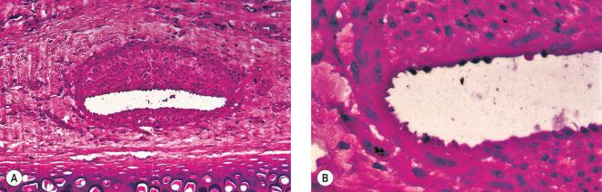 Figure 7.15, Advanced luminal recanalization is present 60 days after injection of polidocanol 0.5%, as seen in cross-section. A, ×100. B, ×200; note endothelial lining on recanalized lumen (hematoxylin–eosin).