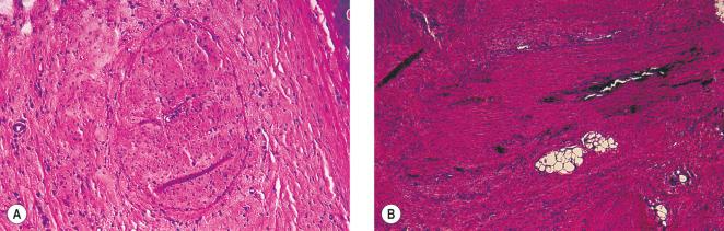 Figure 7.16, Fibrous cord formation is present 30 days after injection of polidocanol 1.0%. The darker areas within the fibrous cord represent hemosiderin-laden macrophages. A, Cross section, ×40. B, Longitudinal section, ×100 (hematoxylin–eosin).