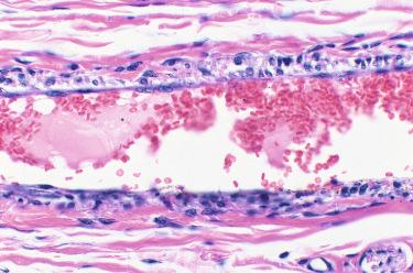 Figure 7.18, Regenerating hyperplastic endothelium is present 8 days after injection of the rabbit ear vein with 0.1% polyiodinated iodine diluted with Sclerodex (hematoxylin–eosin, ×20).