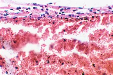 Figure 7.19, Multiple brown spherules approximately 1 µm in diameter are noted within necrotic endothelium at 8 days in the rabbit ear vein injected with 0.5% polyiodinated iodine (hematoxylin–eosin, ×40).