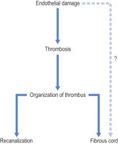 Figure 7.2, Chain of events occurring after sclerotherapy. Ideally, the treated vessel will progress directly from damaged endothelium to a fibrous cord. However, some degree of intravascular thrombosis usually occurs.