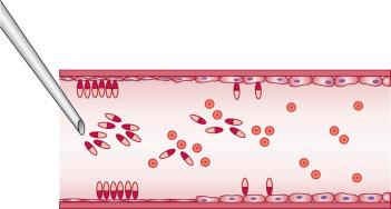 Figure 7.3, Diagrammatic representation of the action of a detergent sclerosing solution on the vessel wall, showing formed elements of the blood.