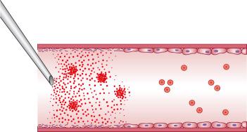 Figure 7.7, Diagrammatic representation of the action of a hypertonic sclerosing solution on the vessel wall, showing formed elements of the blood.