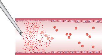 Figure 7.8, Diagrammatic representation of the action of a caustic chemical sclerosing solution on the vessel wall, showing formed elements of the blood.