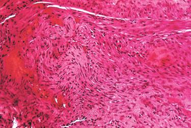 Figure 7.10, Microangiopathic recanalization is apparent 14 days after injection with sodium tetradecyl sulfate 0.5% (hematoxylin–eosin, ×100).