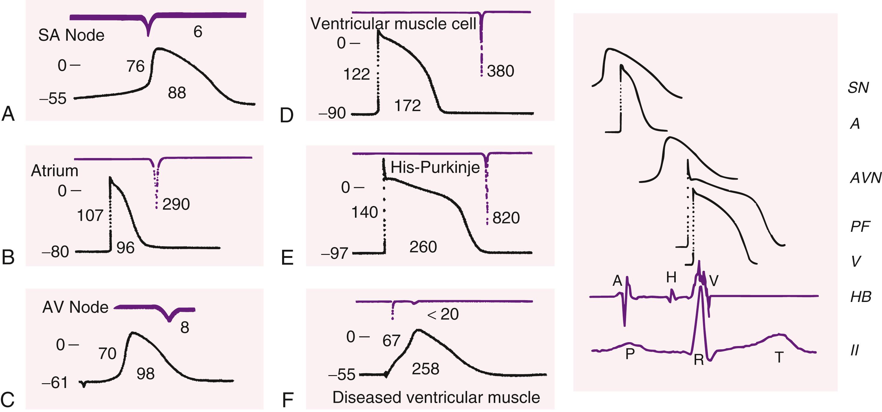 FIGURE 62.5, Action potentials recorded from different tissues in the heart (left) remounted along with a His bundle recording and scalar electrocardiogram from a patient (right) to illustrate the timing during a single cardiac cycle. A to F, Top tracing is dV/dt of phase 0, and the second tracing is the action potential. For each panel, the numbers (from left to right ) indicate maximum diastolic potential (mV), action potential amplitude (mV), action potential duration at 90% of repolarization (milliseconds), and rate of depolarization of phase 0 (V/sec). Zero potential is indicated by the short horizontal line next to the zero on the upper left of each action potential. A, Rabbit sinoatrial node. B, Canine atrial muscle. C, Rabbit AV node. D, Canine ventricular muscle. E, Canine Purkinje fiber. F, Diseased human ventricle. Note that the action potentials recorded in A, C, and F have reduced resting membrane potentials and amplitudes relative to the other action potentials. In the right panel, A, Atrial muscle potential; AVN, atrioventricular nodal potential; HB, His bundle recording; II, lead II; PF, Purkinje fiber potential; SN, sinus nodal potential; V, ventricular muscle potential. Horizontal calibration on the left: 50 milliseconds for A and C, 100 milliseconds for B, D, E, and F; 200 milliseconds on the right. Vertical calibration on the left: 50 mV; horizontal calibration on the right: 200 milliseconds.