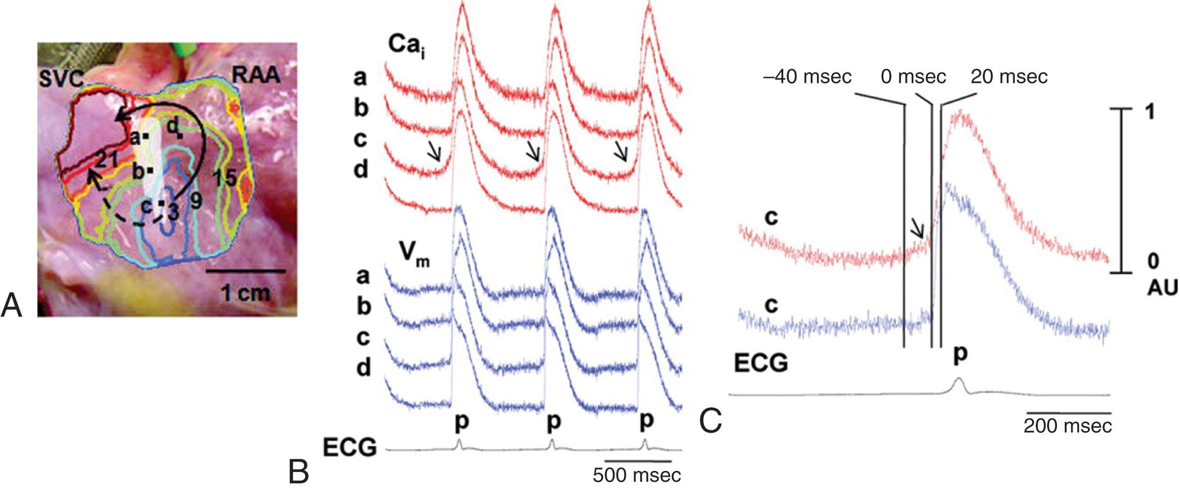 EFIGURE 62.3, Demonstration of late diastolic intracellular calcium elevations in the sinoatrial node in situ by simultaneous optical mapping of changes in intracellular calcium (Ca i ) and transmembrane voltage (V m ) in an isolated canine right atrial preparation. A, Isochronal map of atrial activation during sinus rhythm superimposed on a photograph of the endocardial surface of the sinoatrial node region. The number on each isochronal line indicates the time of activation in milliseconds. The white shaded area is the sinoatrial node. RAA, Right atrial appendage; SVC, superior vena cava. B, V m ( blue ) and Ca i ( red ) recordings from the superior (a), middle (b), and inferior (c) sinoatrial node, and right atrium (d). Arrows indicate late diastolic elevations in Ca i . Note the presence of slow diastolic depolarization in the V m tracings a through c, but not in d. C, Magnified views of Ca i and V m tracings of the inferior sinoatrial node. The late diastolic elevation in Ca i (arrow) precedes rapid upstroke of the sinoatrial and atrial action potential and occurs much earlier than the P wave on the electrocardiogram (ECG).