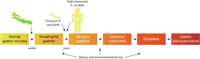 Fig. 63.1, Progression to intestinal-type gastric adenocarcinoma. H. pylori colonization usually occurs during childhood and over a period of weeks, leads to superficial gastritis. The presence of the cag pathogenicity island within H. pylori strains and host polymorphisms that promote high expression levels of the cytokine IL-1β augment the risk of gastric adenocarcinoma over the course of many years. Many other factors such as dietary factors may also influence disease progression.