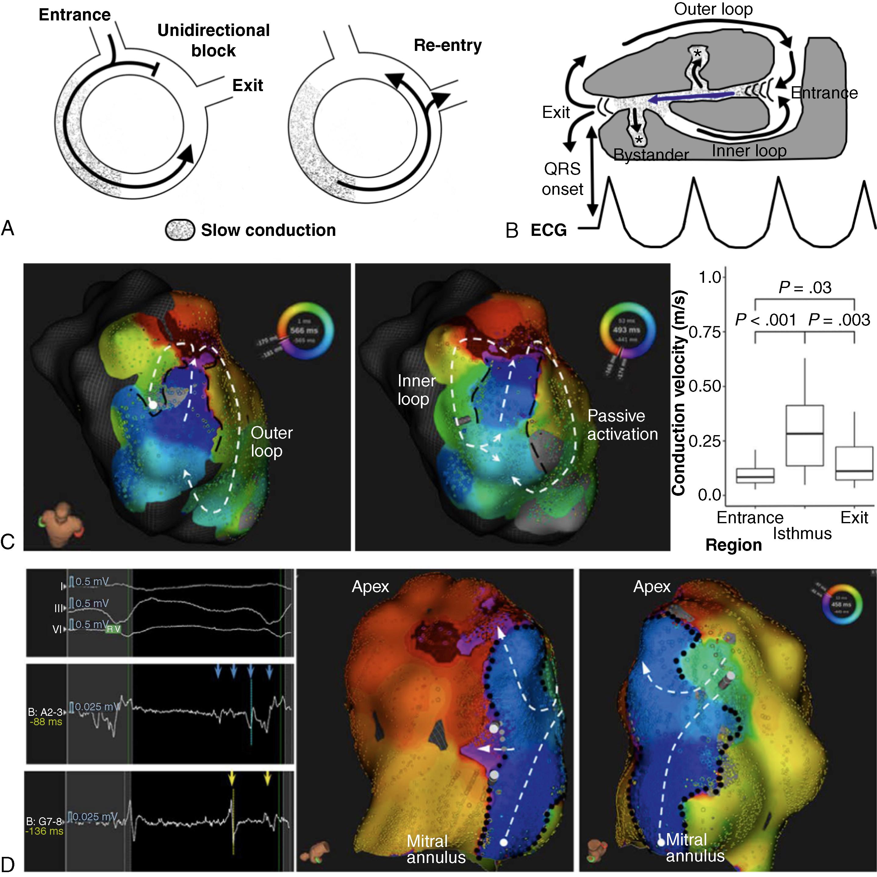 Fig. 46.1, (A) Single circuit of reentry that initiates with unidirectional block. (B) Figure-of-eight circuit with specific sites in the circuit and tracings of the surface electrocardiogram (ECG). Blue arrow indicates the common pathway and protected ventricular tachycardia (VT) isthmus. The VT isthmus and the inner loop are inside the scar. (C) Activation map of VT, including only those beats of cycle length 555 ms (±15 ms; left ) and 485 ms (±15 ms; middle ). Regions with signals less than 0.02 mV are in light gray . Regions with an interpolation distance of more than 5 mm are in hatched dark gray . Offline exclusion of beats based on cycle length has resulted in lower map density. With a shorter cycle length, activation passes via an inner loop within dense scar, and the outer loop appears to be passive. With a longer-cycle length, there is a line of block in the inner loop and activation passes via the longer, outer loop. Right, Median conduction velocity in entrance, isthmus, and exit zones. (D) VT late after myocardial infarction. The isthmus is defined by a combination of lines of complete block (black dots), with clear split signals (yellow arrows), and functional block (gray dots), with fractionated multicomponent electrograms (blue arrows). Activation (white dashed lines) proceeds from a single entrance to an apical exit. There is also activation of a large area of dead-end activation (white circle).