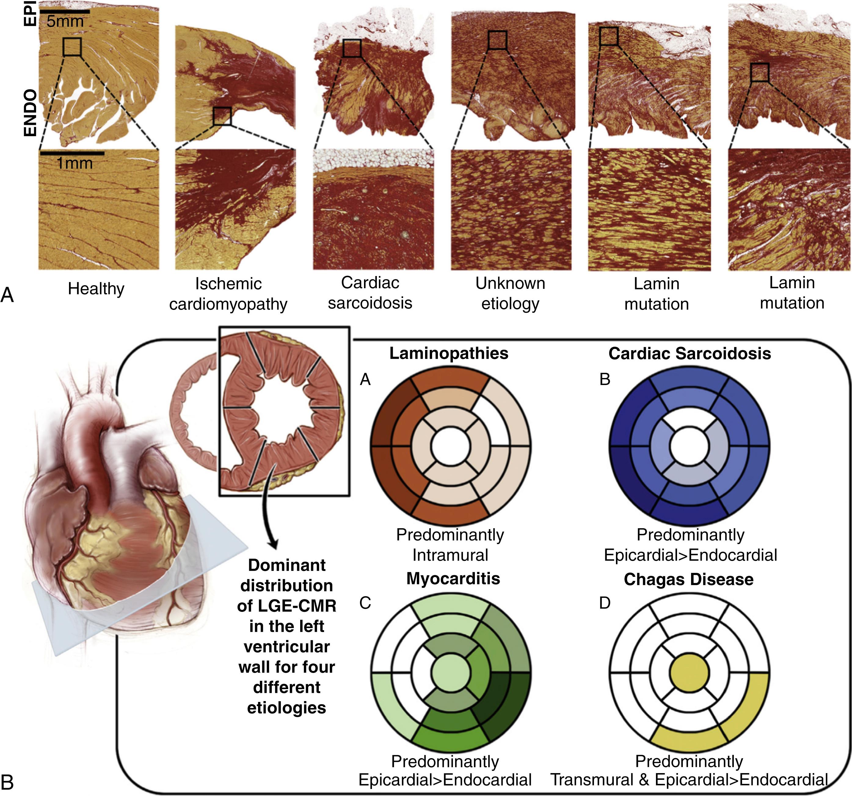 Fig. 46.2, Histopathology of different cardiomyopathy etiologies and representation of dominant substrate locations.