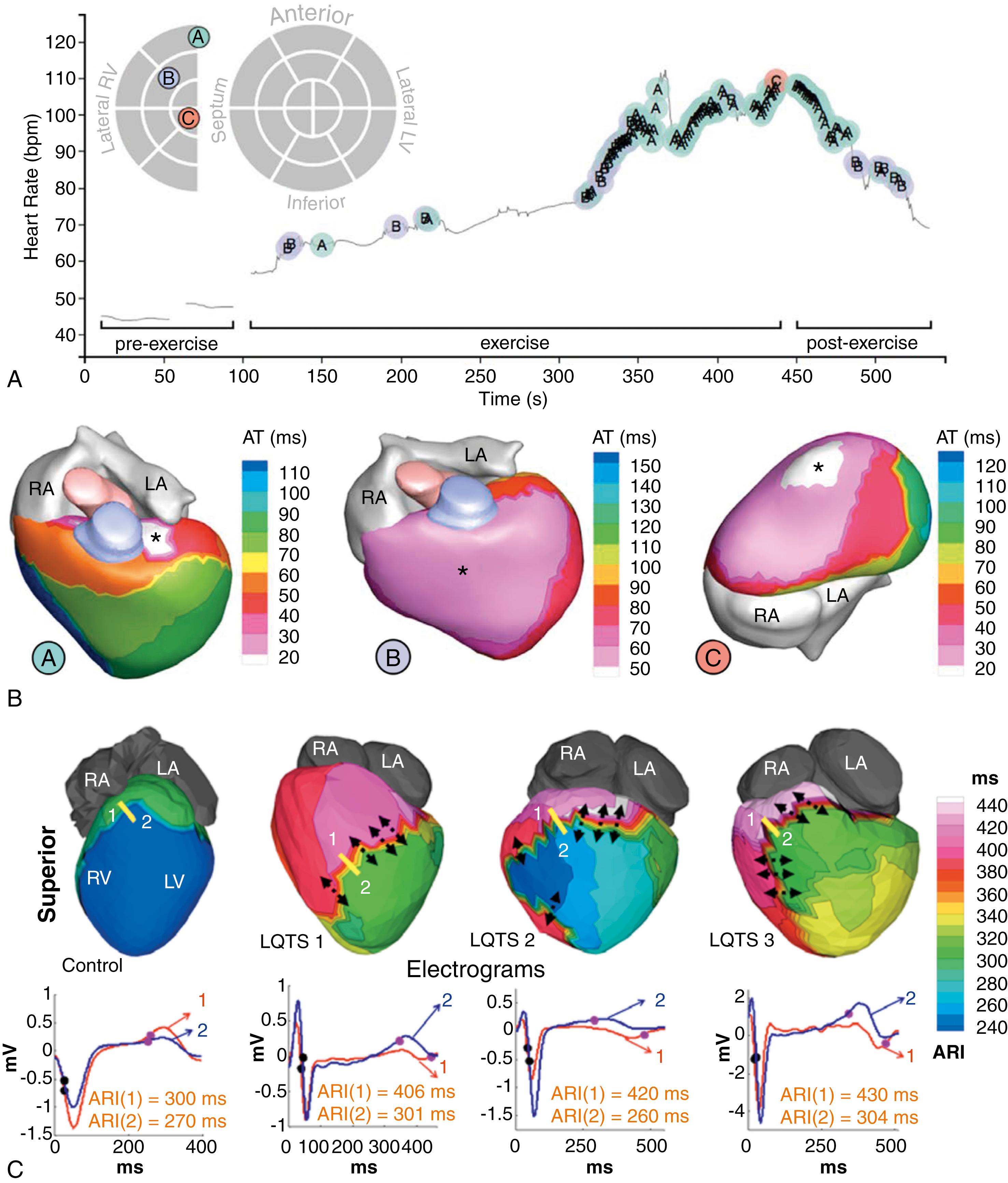 Fig. 46.3, Noninvasive electrocardiographic imaging to study the electrophysiologic substrate of cardiomyopathies.