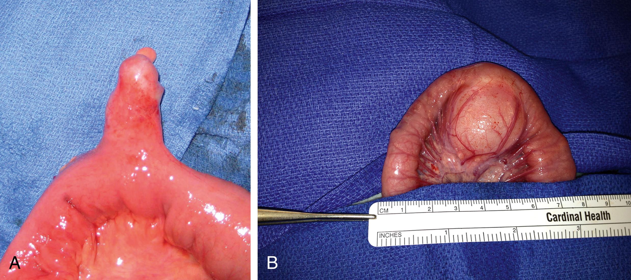 Fig 53.3, Congenital Anomalies of the Distal Ileum.