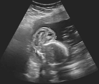 Fig. 133.1, Large occipital encephalocele indicated by calipers.