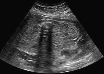 Fig. 133.3, Large, polycystic kidneys.