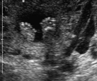 Fig. 133.4, Postaxial polydactyly.