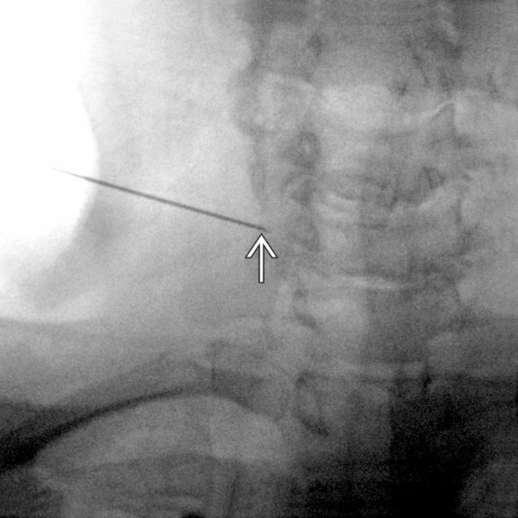 Needle Placement: PA View