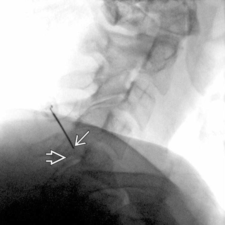 Shoulder Summation Artifact