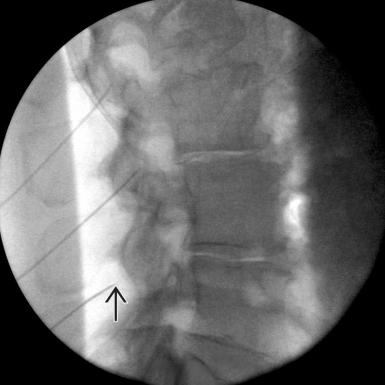 Needle Placement: Lateral View