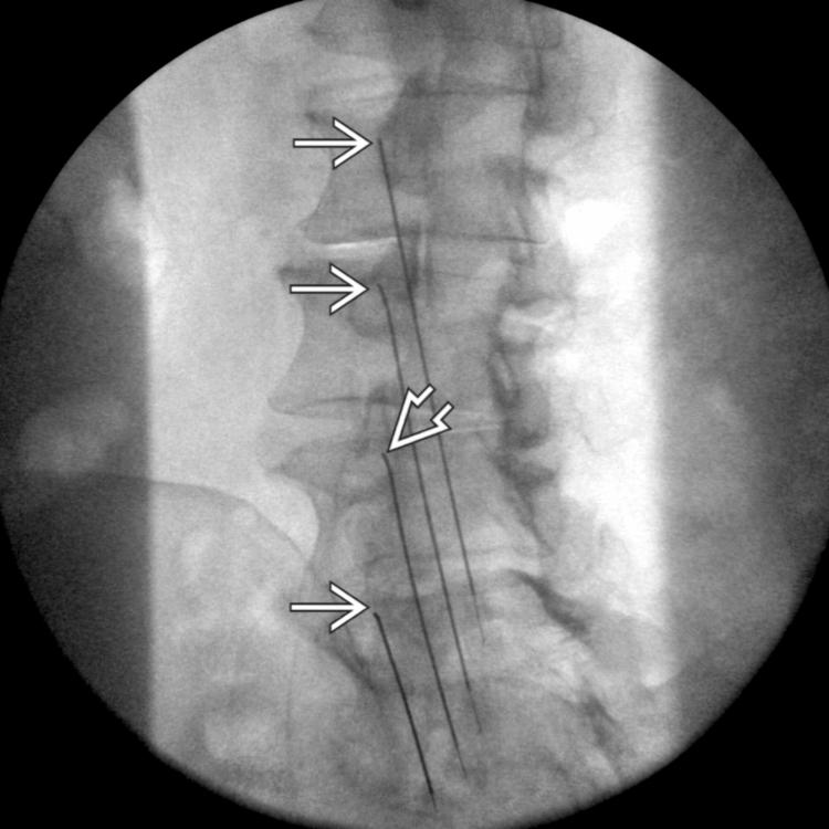 Needle Placement: AP View