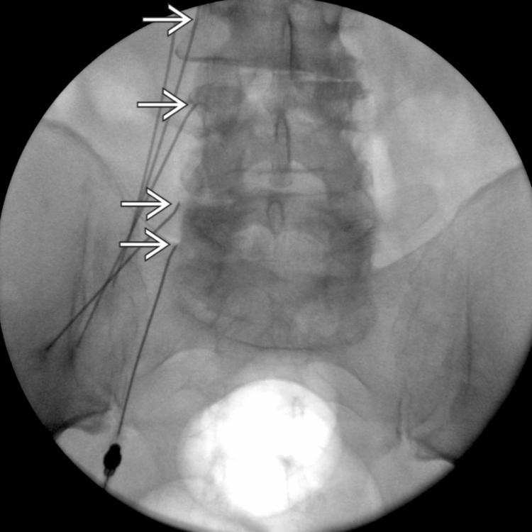 Needle Position: AP View