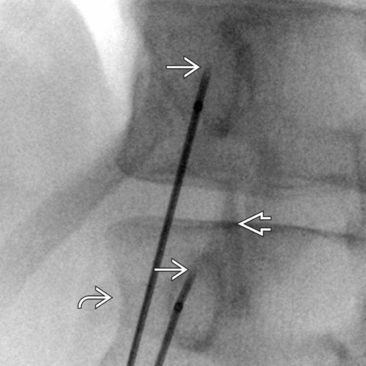 Needle Placement: Oblique View