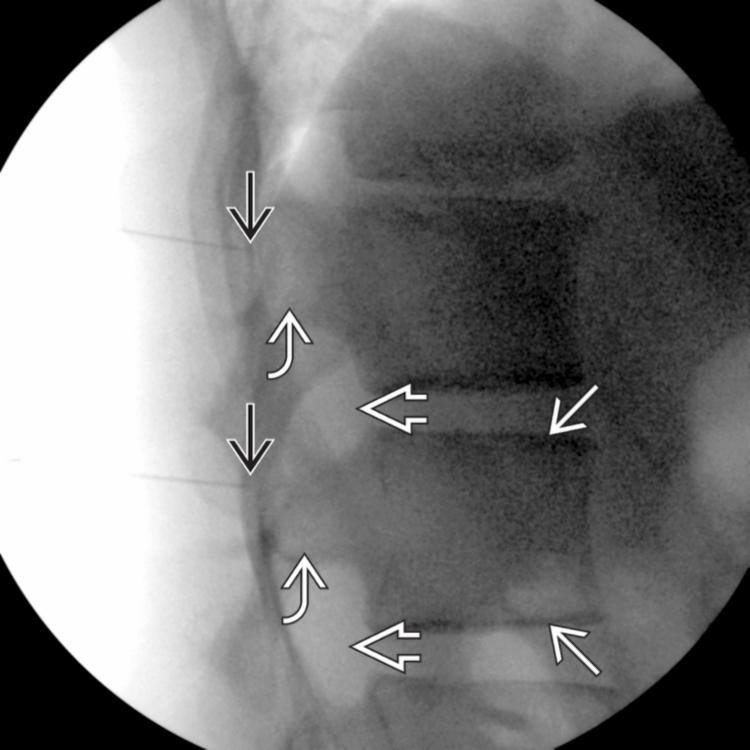 Needle Placement: Lateral View