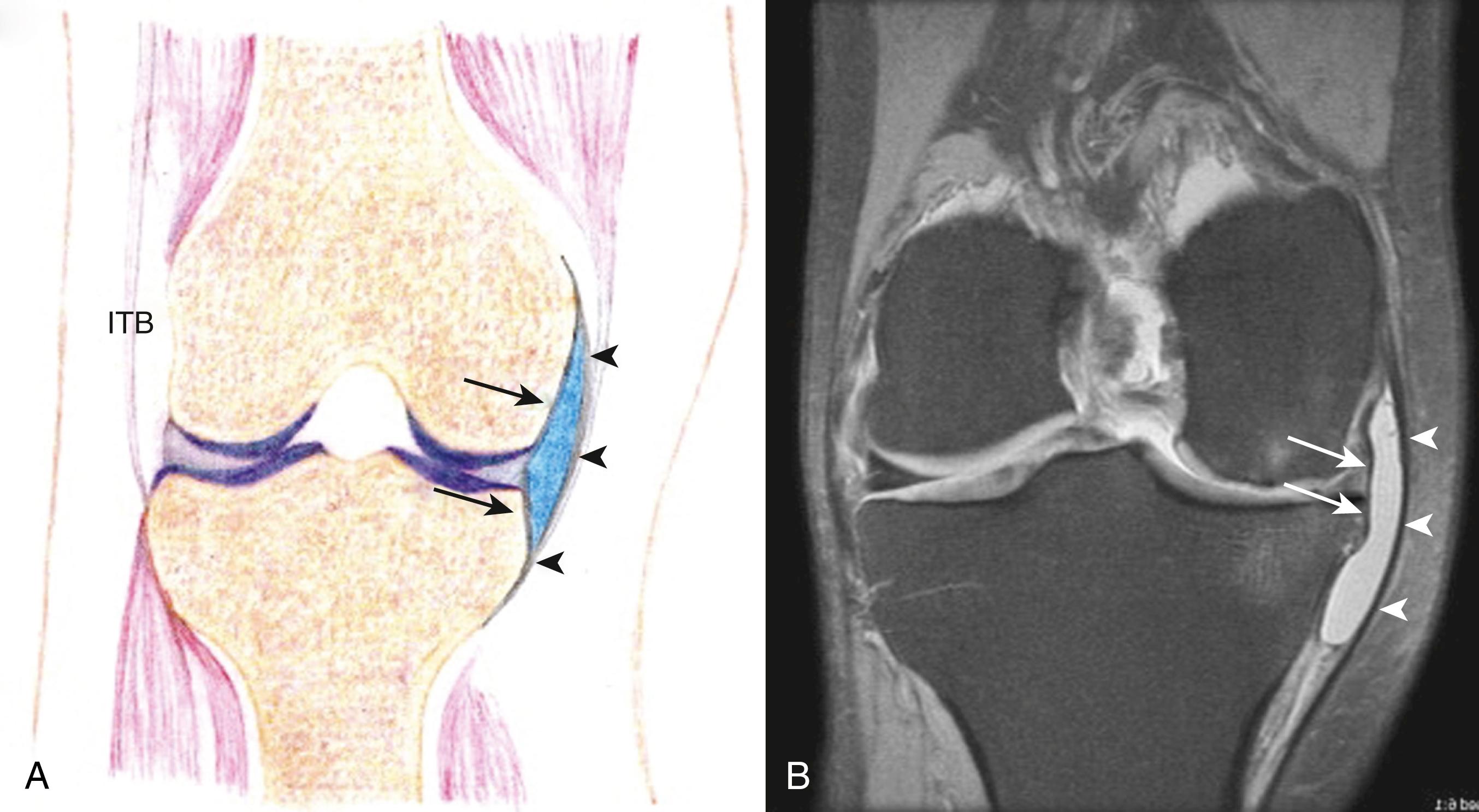 FIG. 163.1, A, Drawing of a medial collateral ligament (MCL) bursitis. This coronal view demonstrates a fluid collection (blue) between the superficial (arrowheads) and deep (arrows) layers of the MCL. B, Coronal proton density-weighted magnetic resonance image with fat suppression demonstrating a fluid collection located between the deep (arrows) and superficial (arrowheads) portions of the MCL, consistent with MCL bursitis. ITB, Iliotibial band.