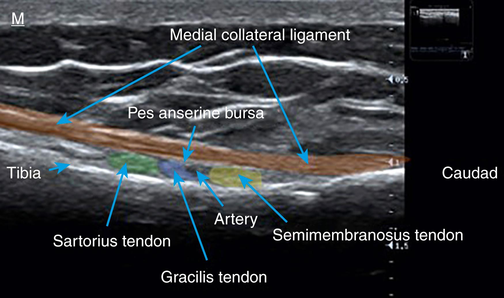 FIG. 163.3, Ultrasound image demonstrating the relationship of the medial collateral ligament and its adjacent structures.