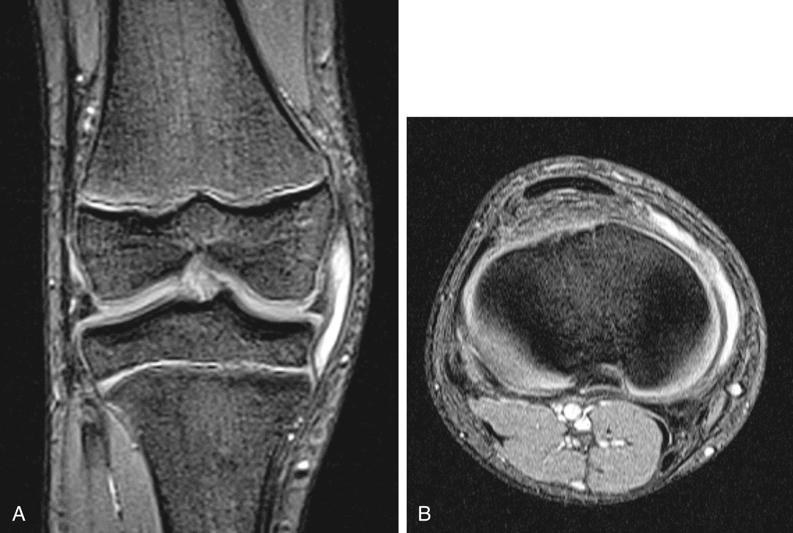 FIG. 163.4, A, Coronal T2-weighted image through the right knee showing a band of increased signal (fluid) between the joint capsule and the medial collateral ligament (MCL) . B, Axial T2-weighted image showing high signal (fluid) between the capsule and the MCL.