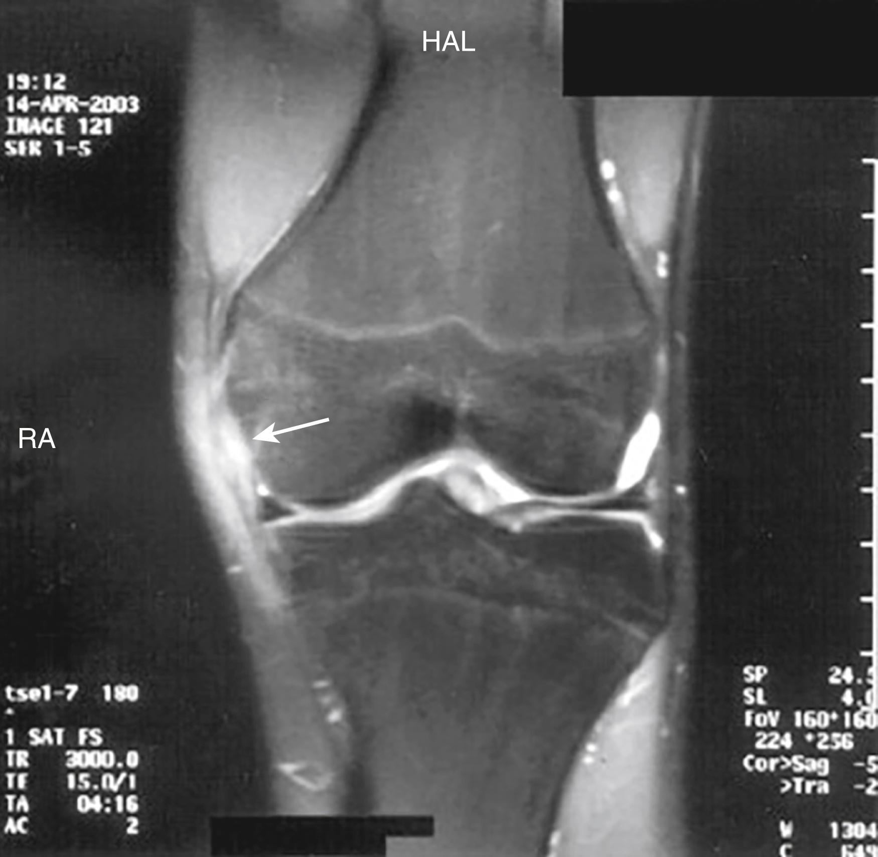 FIG. 163.5, Magnetic resonance imaging of a traumatic injury to the medial knee. A 20-year-old patient with traumatic injury to the medial collateral ligament (MCL) . The arrow points to edema in all 3 layers of the MCL. Bone marrow edema is present in the medial compartment.