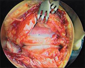 Fig. 101.8, Open surgery confirms complete avulsion of the medial collateral ligament from the tibia with a free-floating, unattached medial meniscus between the articular cartilage of the medial femoral condyle and the tibial plateau.