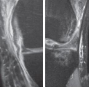 Fig. 101.9, A coronal magnetic resonance image shows tibial-sided avulsion of the medial collateral ligament with retraction and a contrecoup bipolar bone bruise lesion laterally, which suggest a high-energy injury pattern.