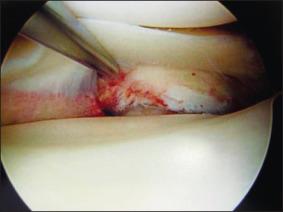 Fig. 101.10, Arthroscopy confirms a drive-through sign with liftoff of the medial meniscus from the tibia, requiring open repair of medial structures.