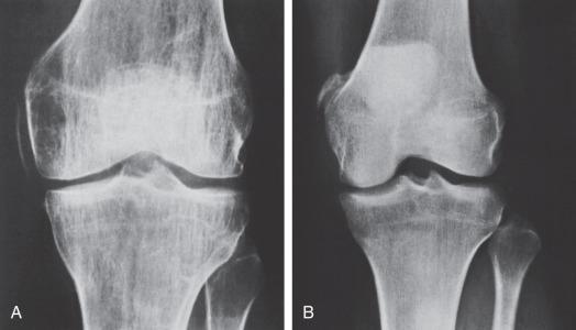 Fig. 101.1, (A) and (B) A Pellegrini–Stieda lesion .