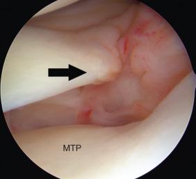 Fig. 101.3, Arthroscopic image of the medial compartment of the knee. The arrow points to the posterior horn of the medial meniscus avulsion injury. MTP, Medial tibial plateau.