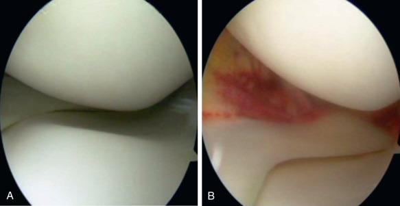 Fig. 101.5, A normal appearing medial joint space (A) is actually shown (B) to have a positive medial drive through sign upon valgus stress and tearing of the posterior medial capsule.