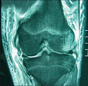 Fig. 101.6, Coronal magnetic resonance image shows complete avulsion of the superficial and deep medial collateral ligament with an unattached medial meniscus.