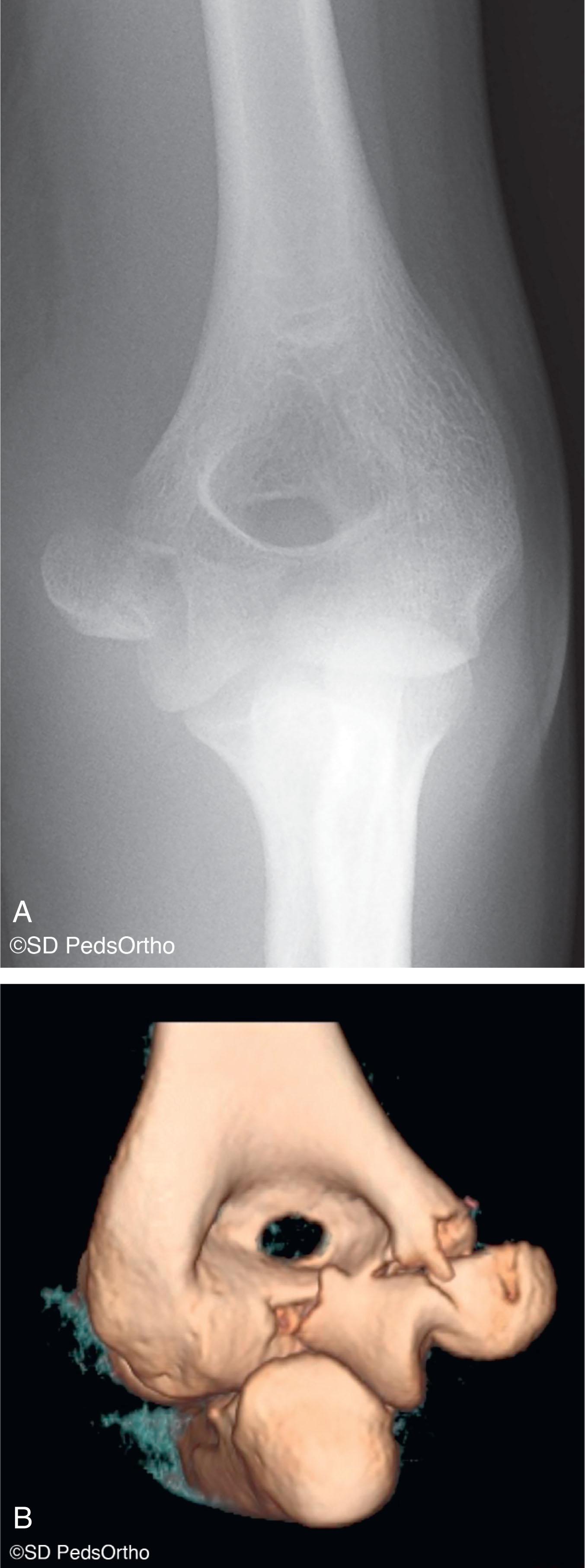 Fig. 4.1, (A) Anteroposterior radiograph showing what appears to be only a medial epicondyle avulsion fracture in a 12-year-old female patient. (B) Computed tomography reconstruction images of the same patient show significant intra-articular extension consistent with a medial condyle fracture.