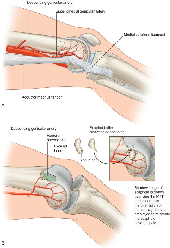 Figure 55.2, (A) Schematic of the anatomy of the descending genicular artery (DGA) and superomedial genicular arterial system. The DGA has perforators to the bone (via the osteoarticular branch), skin (via the saphenous branch), and the muscle. The superomedial genicular branch has a shorter pedicle length and smaller internal diameter than the DGA but is more consistently identified during dissection. (B) Arterial anatomy of the medial femoral condyle flap with particular attention to the harvest of osteoarticular tissue to be used for scaphoid reconstruction.