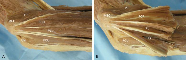 Fig. 28.1, A and B, Photographs of a cadaver elbow demonstrating the ulnar nerve (UN); medial epicondyle (MEC); and the anatomy of the flexor-pronator muscles, including the pronator teres (PT), flexor carpi radialis (FCR), palmaris longus (PL), flexor digitorum superficialis (FDS), and flexor carpi ulnaris (FCU).