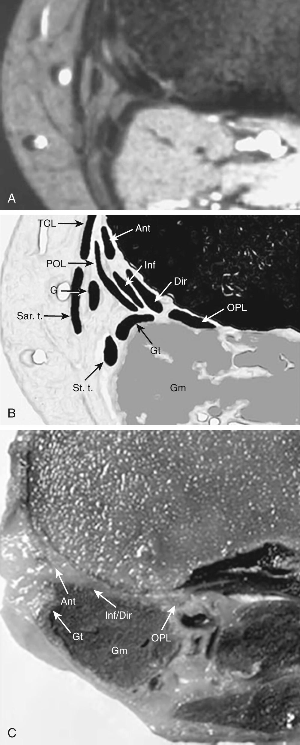 FIG 11.8, Semimembranosus Tendon Complex and Its Divisions/Arms and Their Relationships to Their Surrounding Structures at Various Levels Through the Knee: Level 5—Proximal Tibia