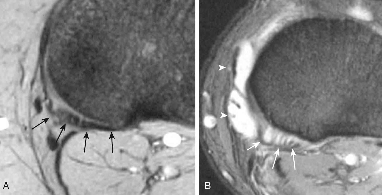 FIG 11.9, Semimembranosus Complex With and Without Presence of a Joint Effusion