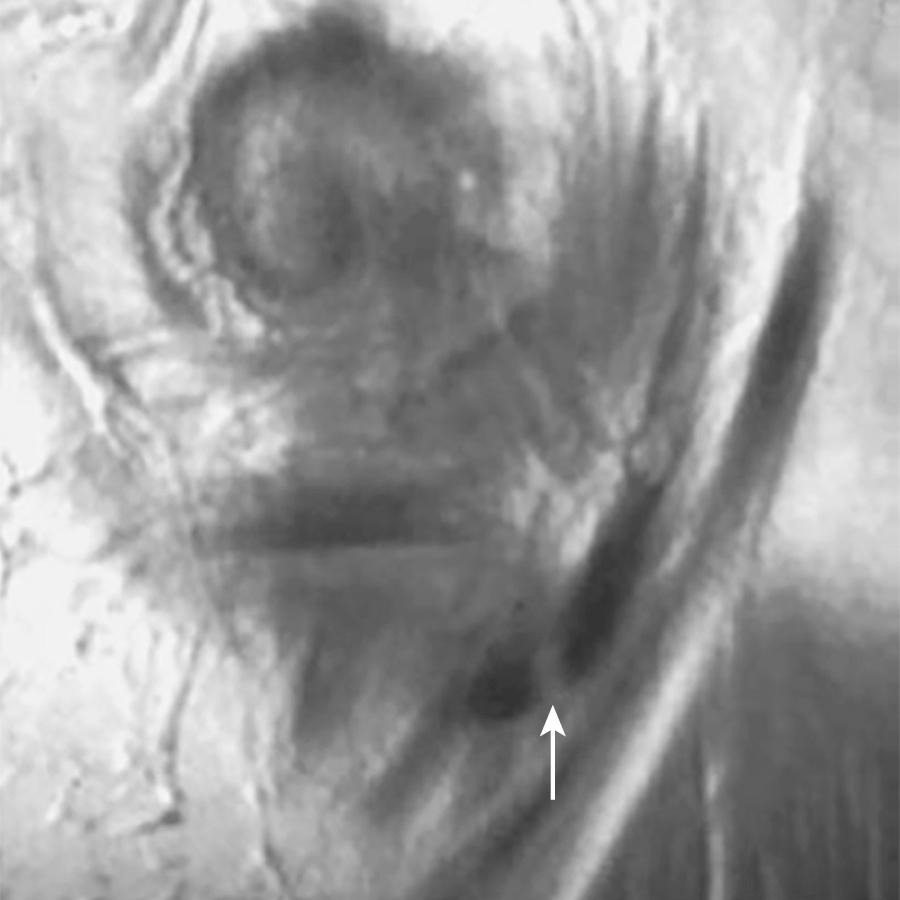 FIG 11.10, Semimembranosus Tendon Complex and the Magic Angle Artifact of the Anterior Division