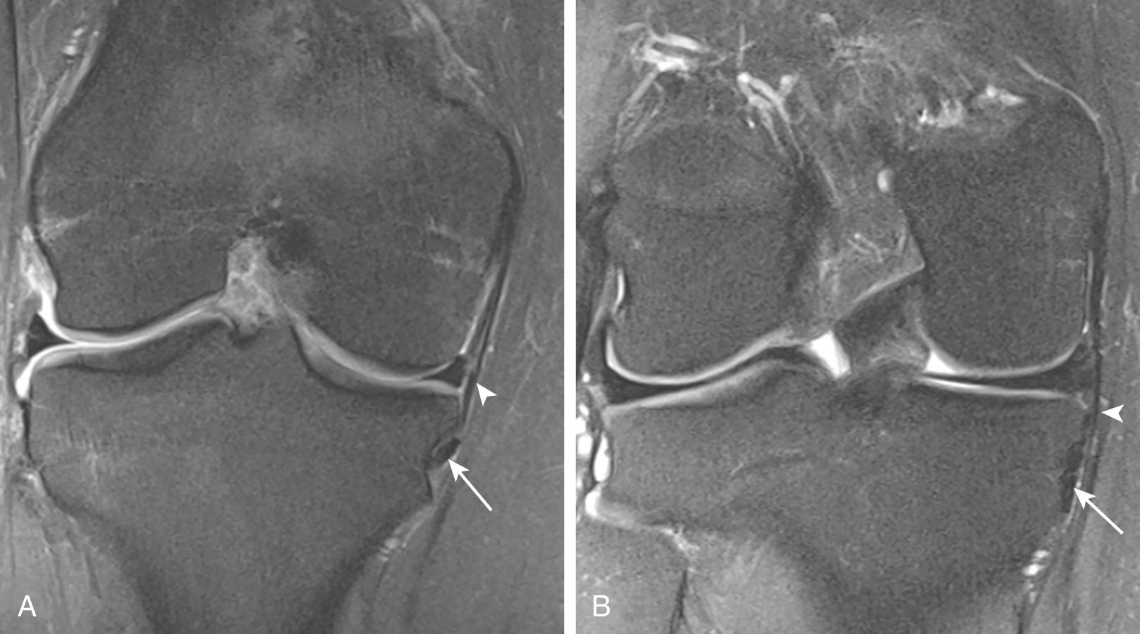 FIG 11.11, Semimembranosus tendon complex Anterior division/arm: Coronal fat-saturated proton density MR images demonstrating the anterior arm (A) as a round or oval, thick low-signal-intensity tendon (arrow) or (B) as a thin tendon (arrow) . Note the POL ( arrowheads in A and B) covering the anterior arm.