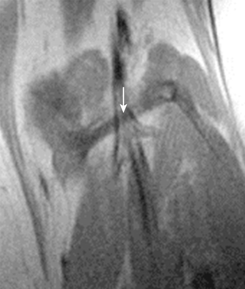 FIG 11.12, Oblique Popliteal Ligament