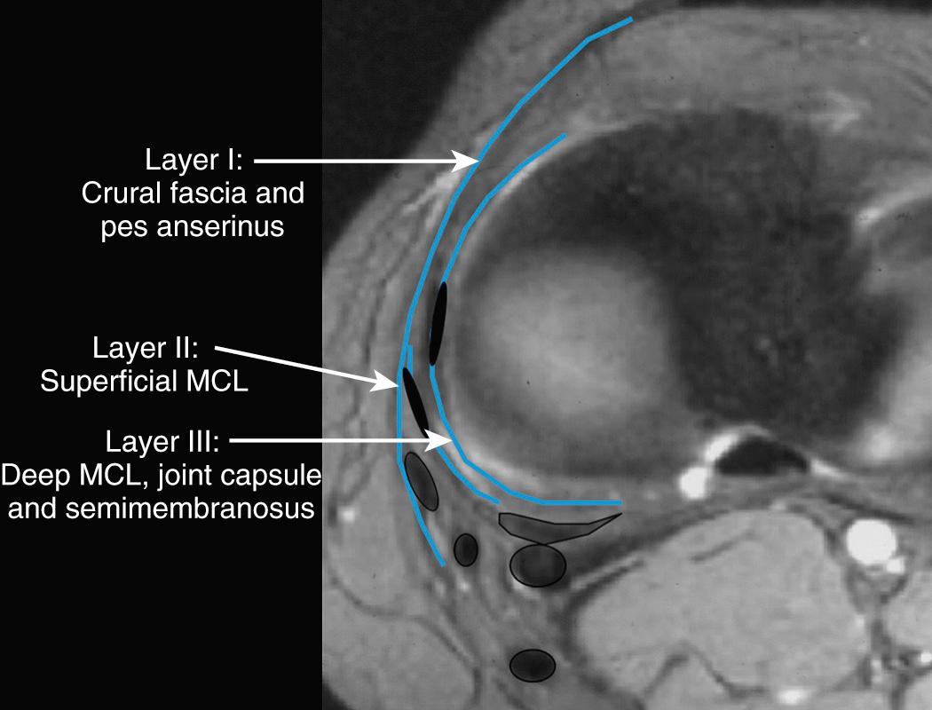 FIG 11.2, Three Layers of the Medial Corner Structures