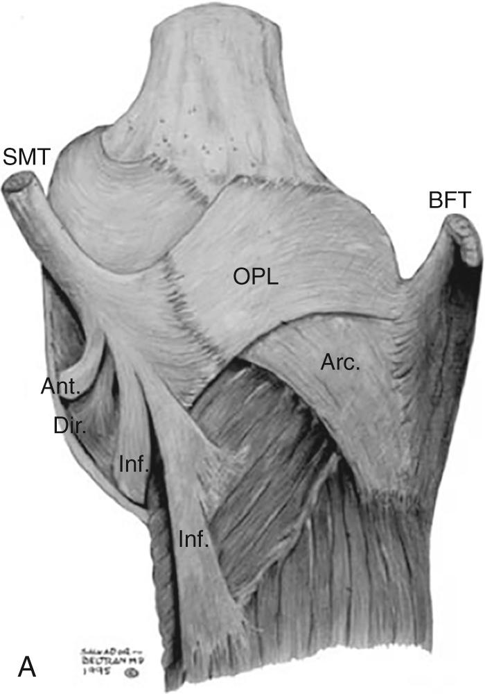 FIG 11.3, (A) Semimembranosus tendon complex: Anatomic illustration demonstrating the various arms/divisions of the complex and their relationships to each other, the oblique popliteal ligament (OPL), the arcuate ligament, and the biceps femoris tendon (BFT). This illustration highlights the semimembranosus tendon (SMT) located in the posterior medial aspect of the knee and its five divisions: [1] anterior arm (Ant) , [2] direct arm (Dir) , [3] inferior arm (Inf) , [4] OPL, and [5] capsular arm. The capsular arm is located deeper and not depicted in this image. Note the relationship between the OPL and the arcuate ligament (Arc) . The biceps femoris tendon (BFT) is seen in the posterolateral aspect of the knee. BFT, Biceps femoris tendon; OPL, oblique popliteal ligament; SMT, semimembranosus tendon.